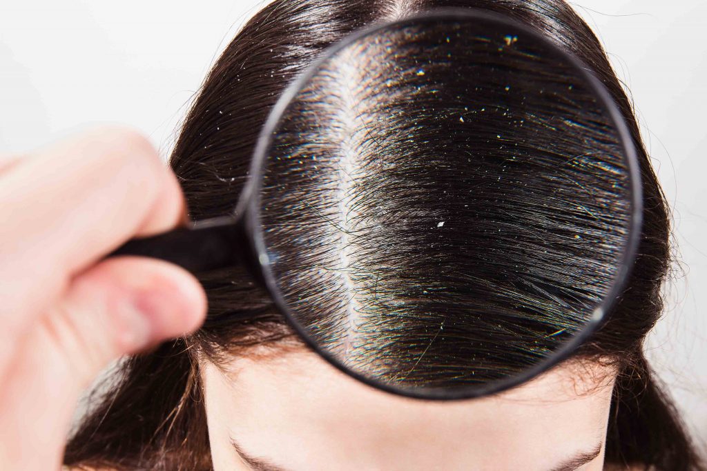 doctor looks through magnifying glass dandruff dark female hair
